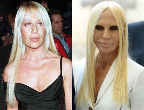 versace donnatella|donatella versace before and after surgery.